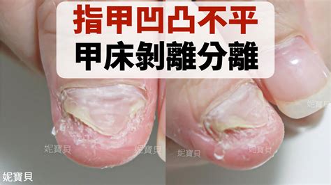 腳指甲受傷|一次了解指甲層狀剝離、指甲凹洞等7種指甲異常狀況…